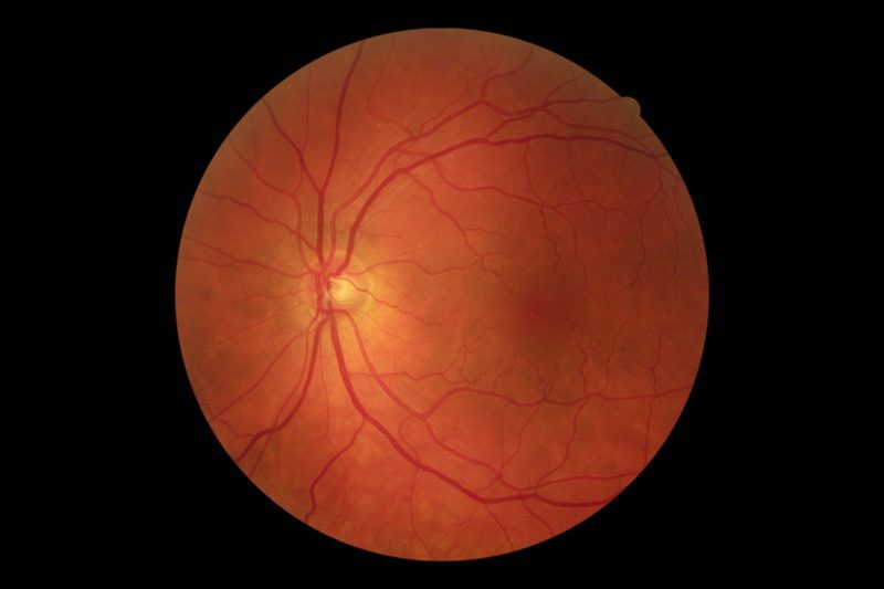 Diabetes + Your Eyes: Resources for North Carolina Residents Diabetes + Your Eyes: Resources for North Carolina Residents